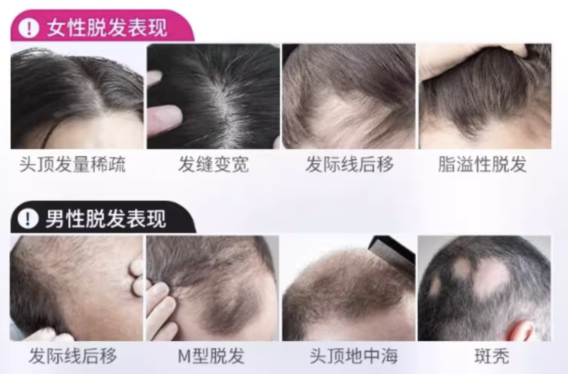 告别脱发困扰，达霏欣让自信从头出发